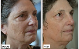 Laser Skin Tightening in Islamabad