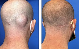 Lipoma Treatment before after