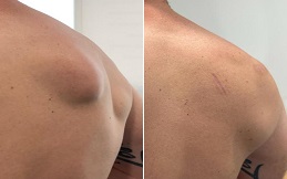 Lipoma Treatment in Islamabad