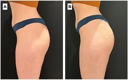 Macrolane Injection in Islamabad