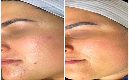 Micro Needling with PRP Therapy before after