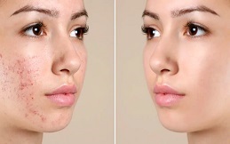 Micro Needling with PRP in Islamabad