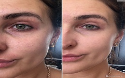 Nano Thread Lift before after results