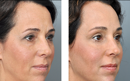 Nano Thread Lift in Islamabad