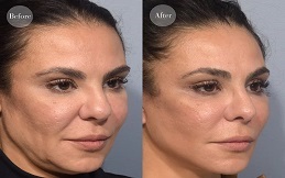 Nano Thread Lift treatment in Islamabad