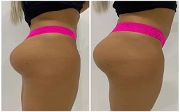 Non-Surgical Bum Lift before after results