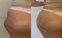 Non-Surgical Bum Lift before after