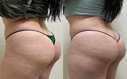 Non-Surgical Bum Lift in Islamabad