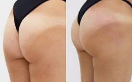 Non-Surgical Bum Lift