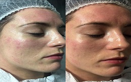 Oxygen Facial before after results