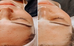 Oxygen Facial cost in Islamabad