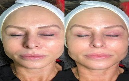 Oxygen Facial in Islamabad