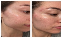 PICO Laser Treatment before after results
