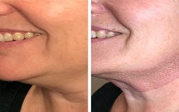 Plasma Pen Treatment before after results