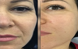 Radio Frequency Treatment before after results