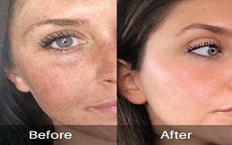 Removal Of Melasma And pigmentation before after
