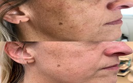 Removal Of Melasma And pigmentation in Islamabad