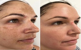 Removal Of Melasma And pigmentation