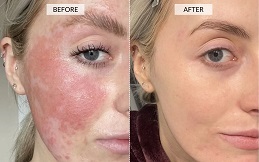 Rosacea Treatment before after results