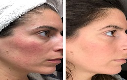 Rosacea Treatment before after