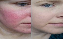 Rosacea Treatment in Islamabad