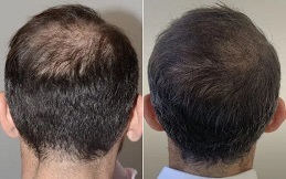 Scalp Micropigmentation before after results