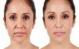 Silhouette Facelift before after