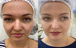 Spectra Laser Carbon Peel before after results