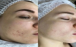Spectra Laser Carbon Peel before after
