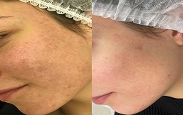 Spectra Laser Carbon Peel in Islamabad