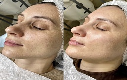 Spectra Laser Carbon Peel