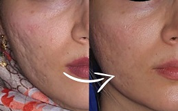 Subcision Treatment for Acne Scars before after results