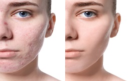 Subcision Treatment for Acne Scars before after