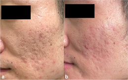 Subcision Treatment for Acne Scars cost in Islamabad