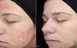 Subcision Treatment for Acne Scars in Islamabad