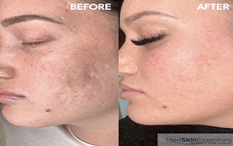 Subcision Treatment for Acne Scars