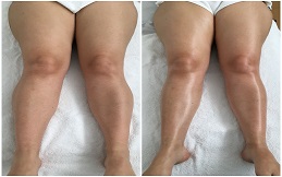 Thigh Lift surgery in Islamabad