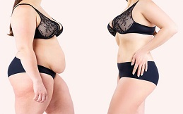 Tummy Tuck Treatment in Islamabad