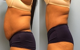 Tummy Tuck surgery in Islamabad
