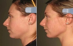 Ultherapy Treatment before after results