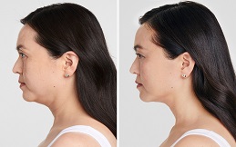 Ultherapy Treatment before after