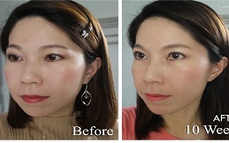 Ultherapy Treatment cost in Islamabad