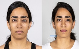 Ultherapy Treatment in Islamabad