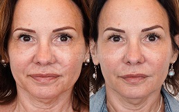 Ultherapy Treatment