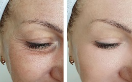 Under Eye fillers before after