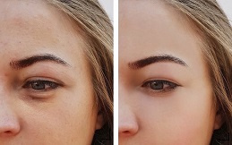 Under Eye fillers in Islamabad