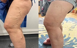Varicose Veins Treatment before after results