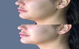 best Aqualyx injection in Islamabad