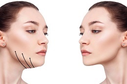 best Belkyra Treatment before after