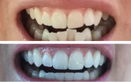 best Invisible Braces in Pakistan